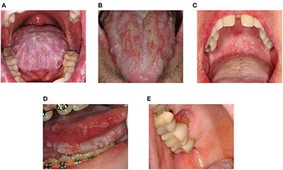 Oral Chronic Graft-Versus-Host Disease
